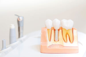 model of the different types of dental implants