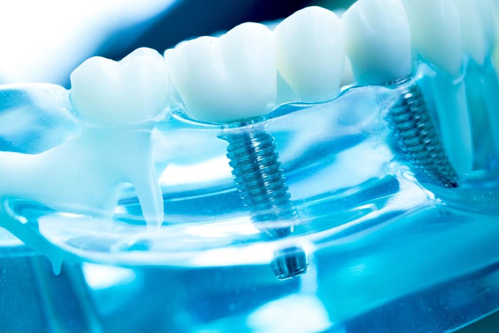 Close-up of model of dental implants to show the benefits of dental implants