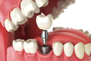 Model of dental implants to help people looking for dental implants in Durham NC